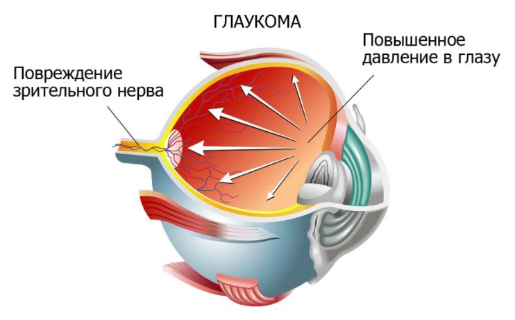 глаукома 