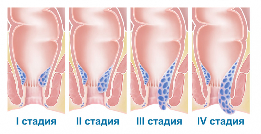 лечение геморроя