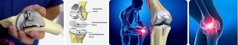 Эндопротезирование коленного сустава