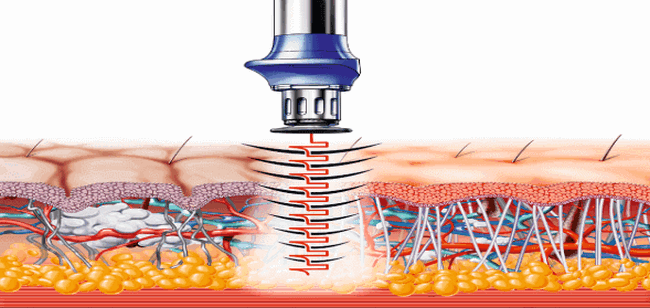 ударно-волновая терапия 