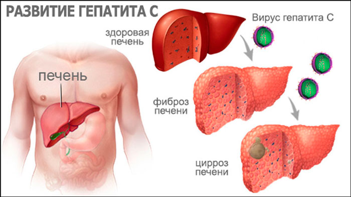 Развитие болезни