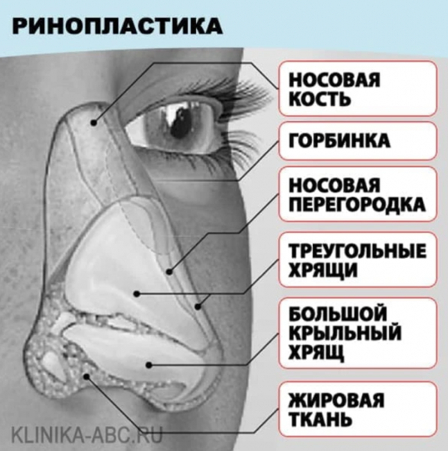 Нос с горбинкой — как исправить? - Центр пластической хирургии Daily Medical