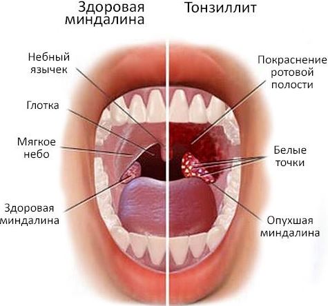 Тонзиллит 