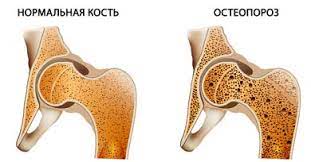 Остеопороз