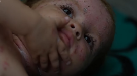 Из-за условий жизни в секторе Газа дети и взрослые заражаются кожными заболеваниями