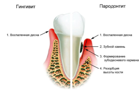 Пародонтит презентация на английском